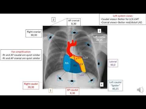 How to read  a coronary angiography