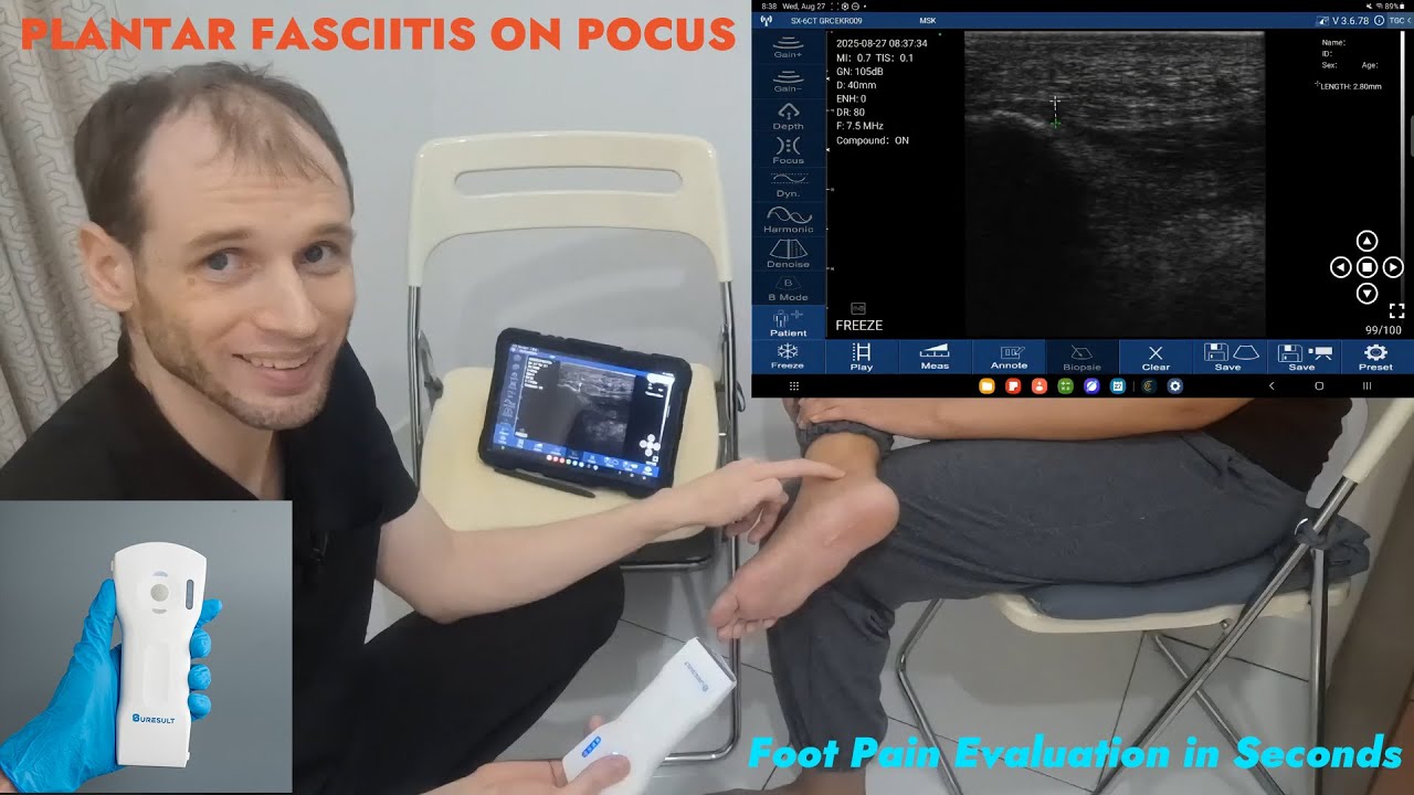 Pocus Foot Injection POCUS for Plantar Fasciitis | Quick Foot Pain Scan with Suresult ...