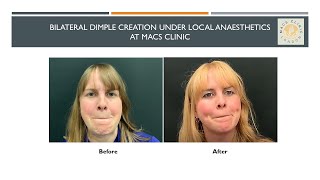 Testimonial by a happy patient following dimple creation procedure at MACS Clinic - Part 1