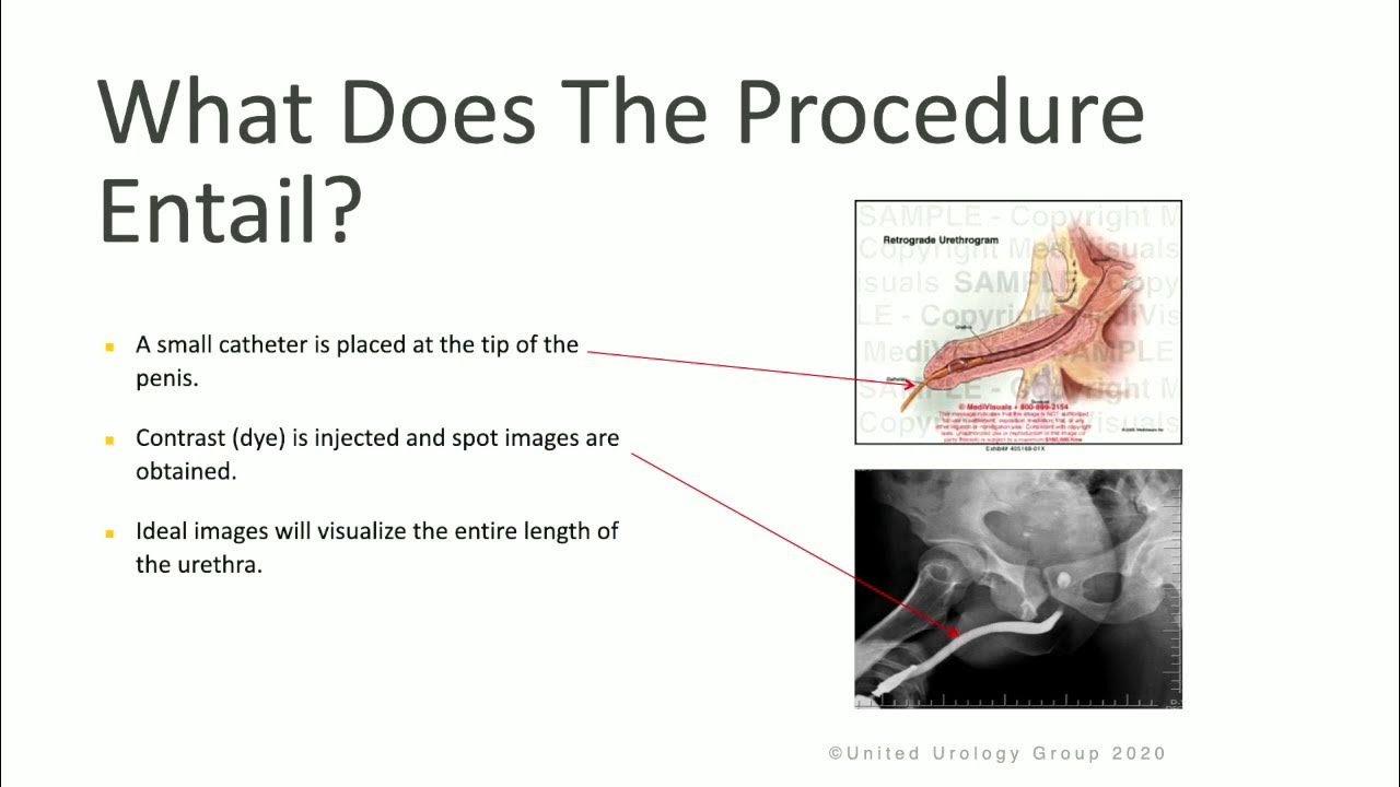 Retrograde Urethrogram & voiding Cystourethrogram YouTube