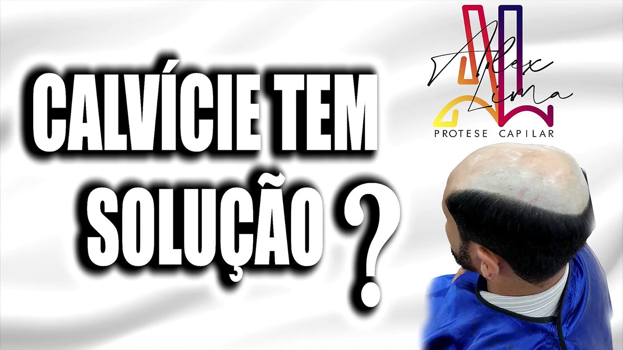 CALVÍCIE TEM SOLUÇÃO? - PRÓTESE CAPILAR RJ - ALEX LIMA (21) 9 9411-4531 ...