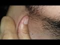 Relaxing beard hair Massage therapy | Skin care routine | Ingrown hair video 
