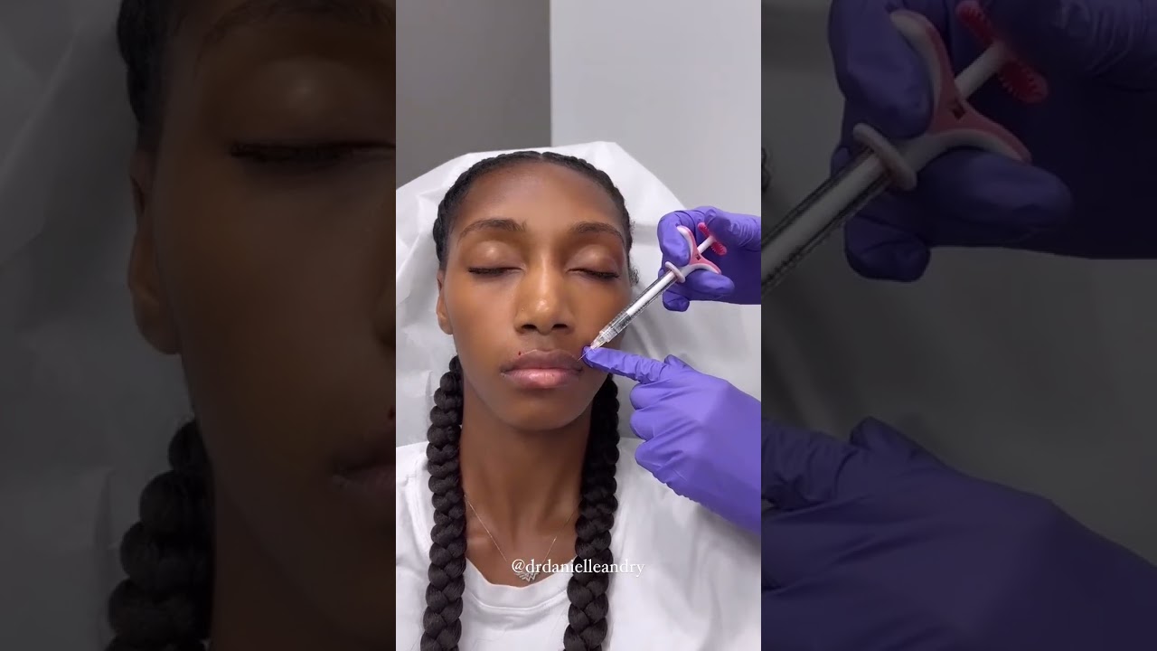 A peek into a lip filler appointment with me  | 