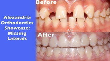 Alexandria Orthodontics Showcase: Missing laterals⁠