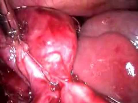 Laparoscopic Cholecystectomy (unedited 54)-Acute Cholecystitis-Two Weeks Pain Lump With Empyema