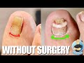 FIXING A PINCER TOENAIL WITHOUT SURGERY ***SEVERE INGROWN TOENAIL TREATMENT***