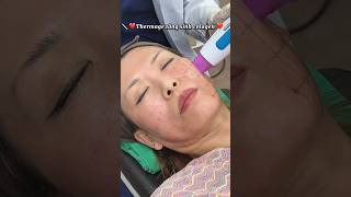 Liệu pháp Thermage giúp trẻ hóa da, nâng cơ