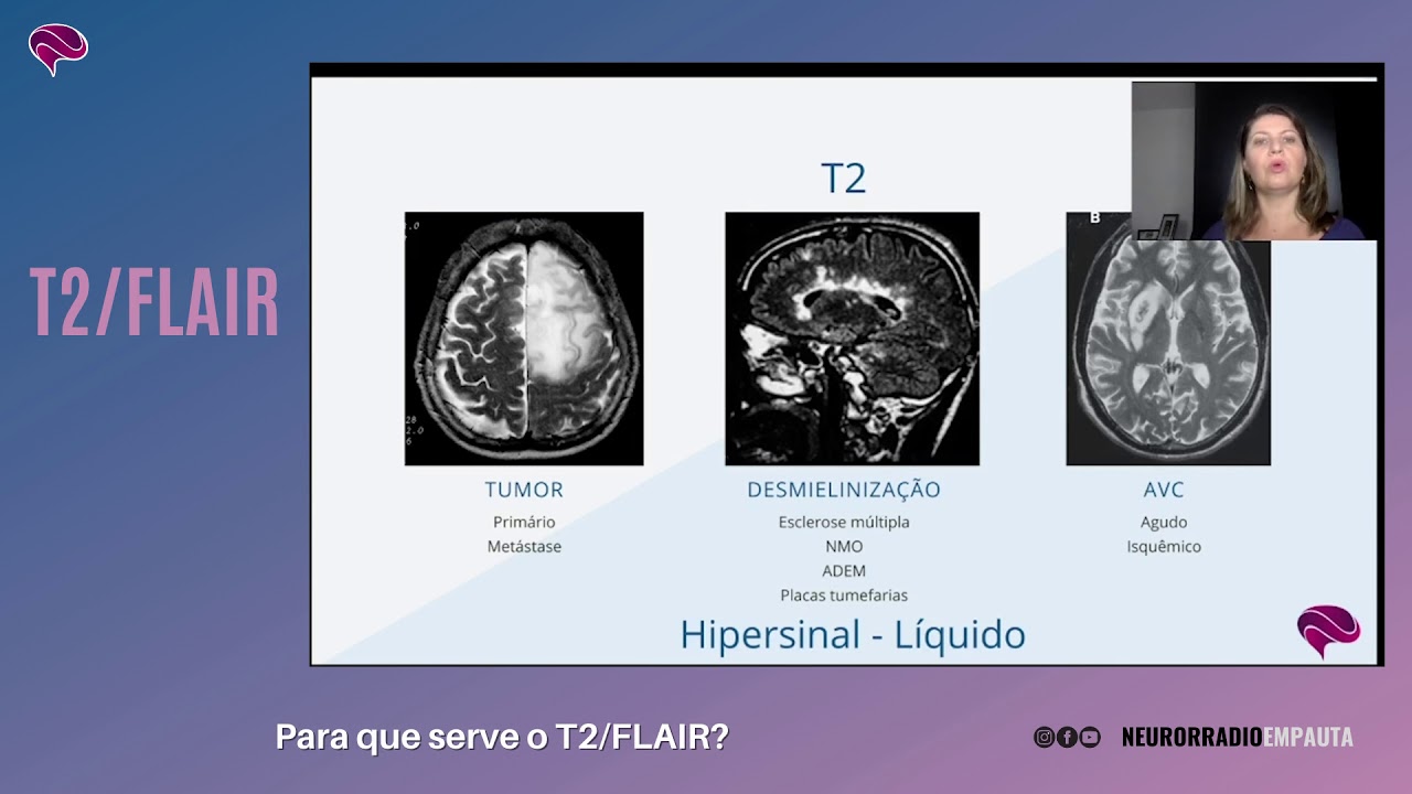 Foco De Hipersinal Em T2 E Flair - METOBRAIN