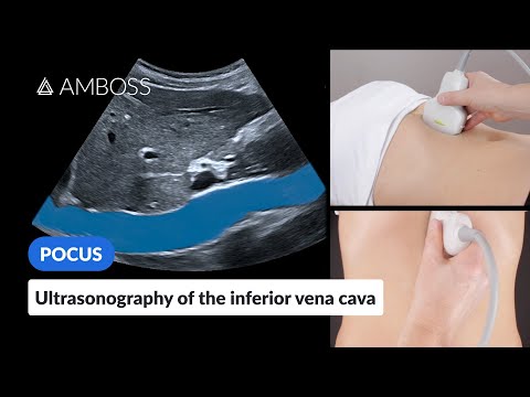 Video: Untuk. vena cava inferior?