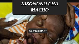 Sababu Watoto Kuzaliwa Na Kisonono Cha Macho