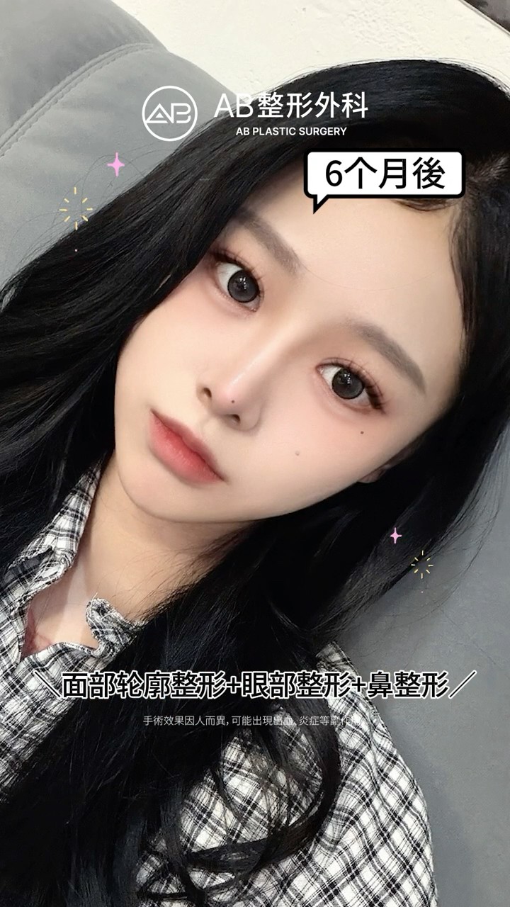 輪廓三件套、眼整形、鼻整形前後對比✨ #Shorts