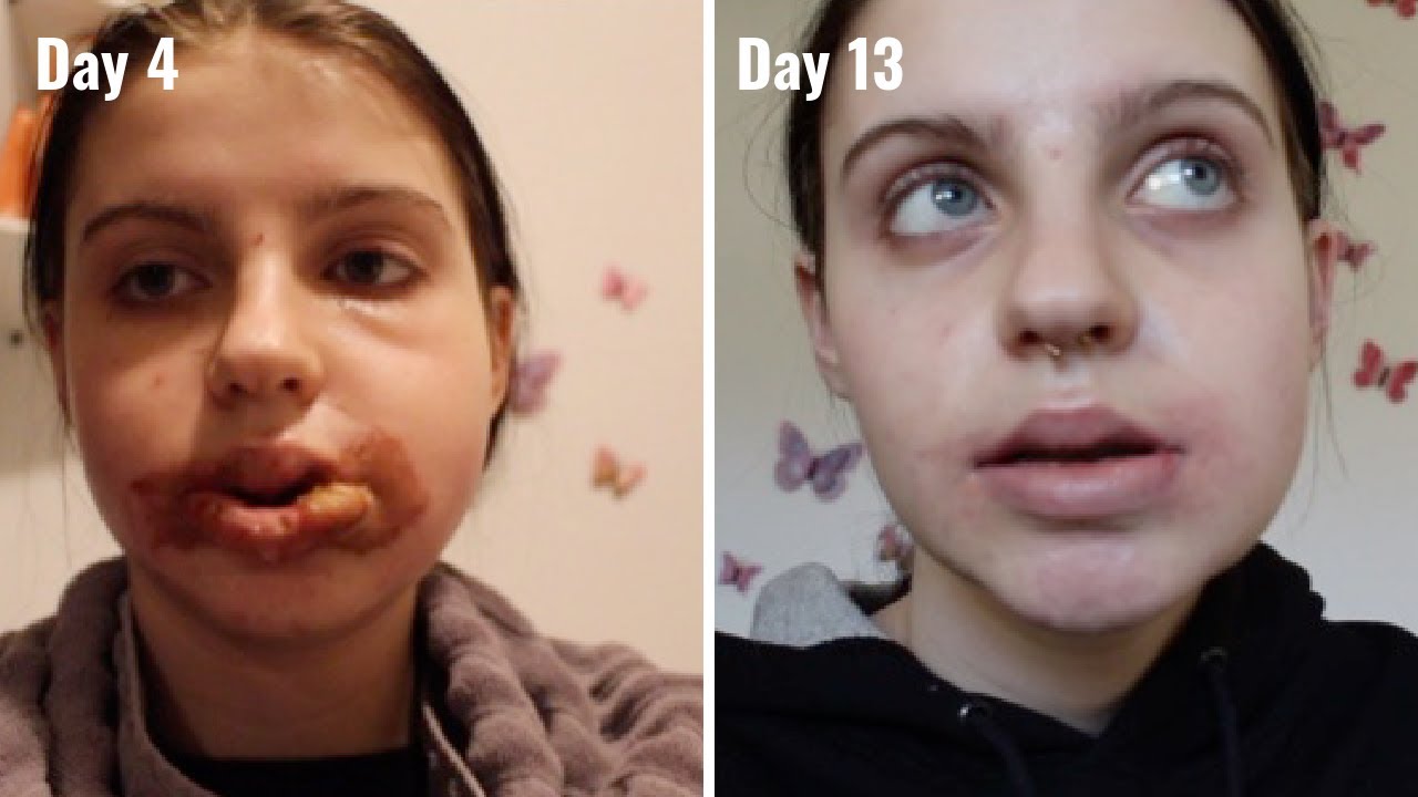 Double Jaw Surgery Days 413 YouTube