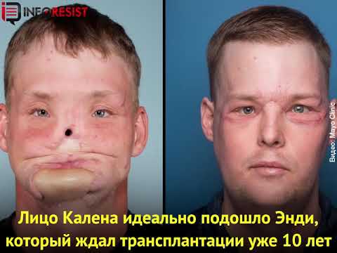 Эмоциональная встреча мужчины с вдовой донора, чье лицо ему пересадили