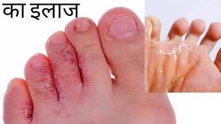 Athlete's foot symptoms and treatment | Athlete's foot home remedies with cream screenshot 4