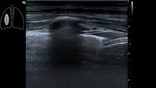 Ecografía Pulmonar en Pediatría: Límite Torax - Diafragma -Abdomen