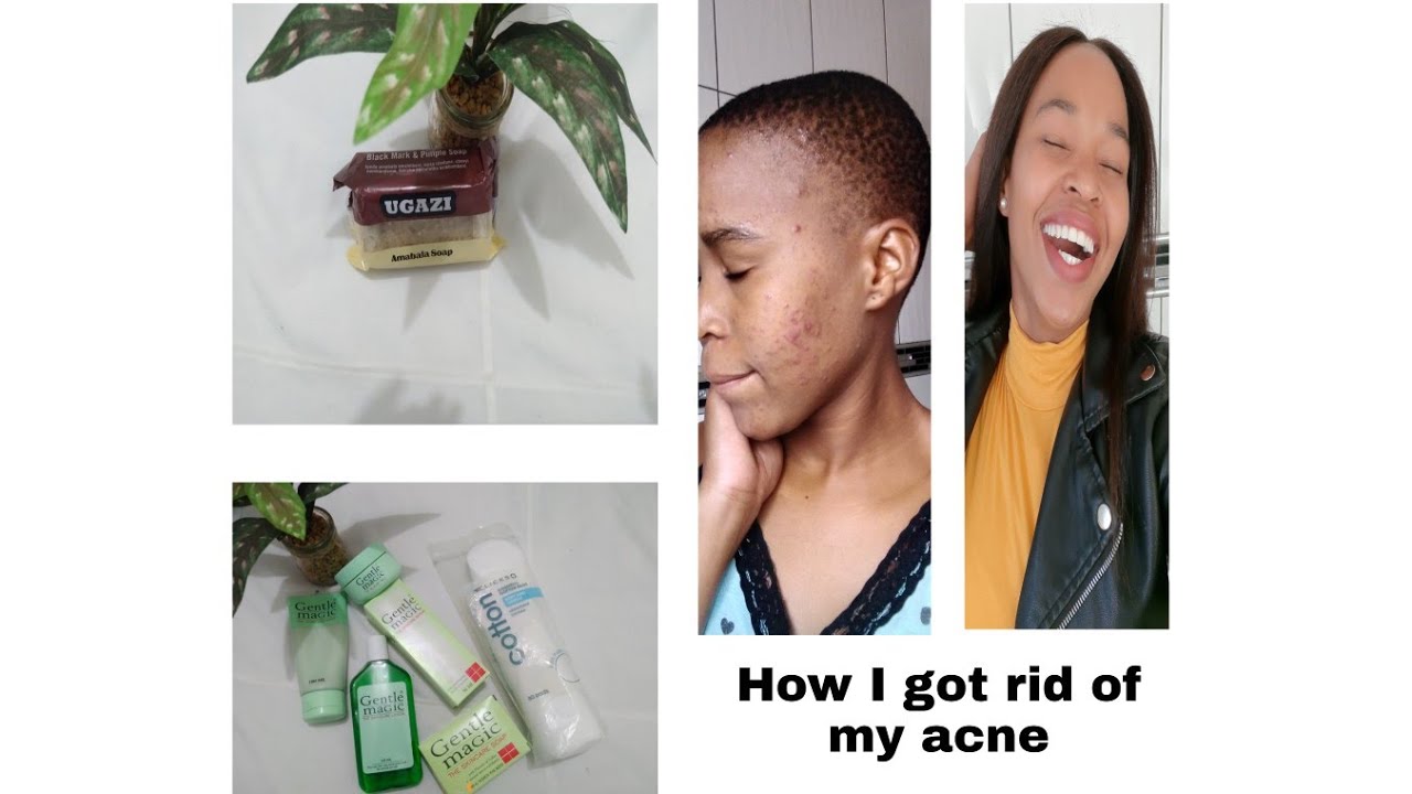 How I got rid of my acne in 3 weeks time | Skincare routine | South ...