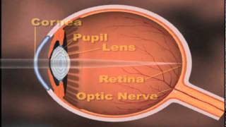 Download Lagu Glaucoma.VOB MP3