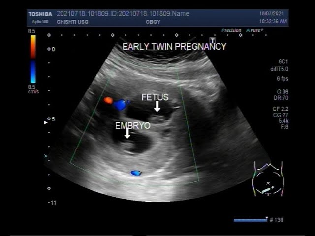 8 week ultrasound fraternal twins