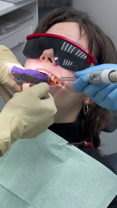 Снятие слепков перед изготовлением коронки🔍🦷 #teeth #smile # ...