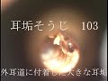 耳垢そうじ/ガサガサする大きな耳垢/103