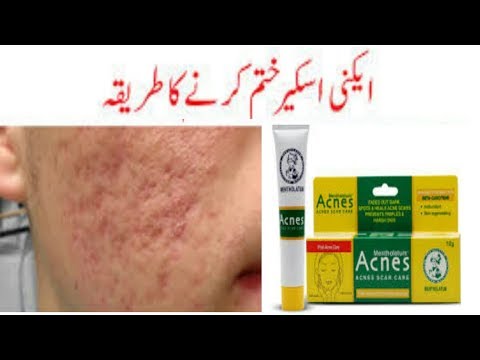 HOW TO REMOVE ACNE SCARS\\ Dark spots  Removal Treatments review in urdu