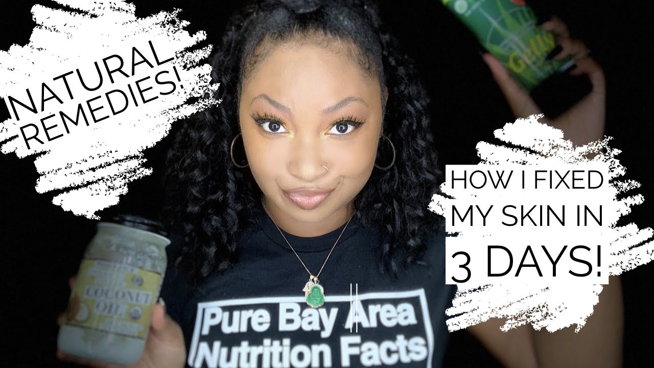 How I Fixed My Skin in 3 DAYS!!! Using Natural Remedy: COCONUT OIL ...