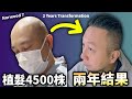在日香港人,日本植髮4500株兩年結果!費用如何?後頭部狀況公開㊙