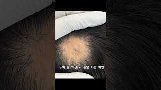 20대 원형 탈모 관리 정상화의 여정 #헤드스파 #대구헤드스파 #20대원형탈모 #림프관리 #탈모관리 #림프순환 #스트레스탈모