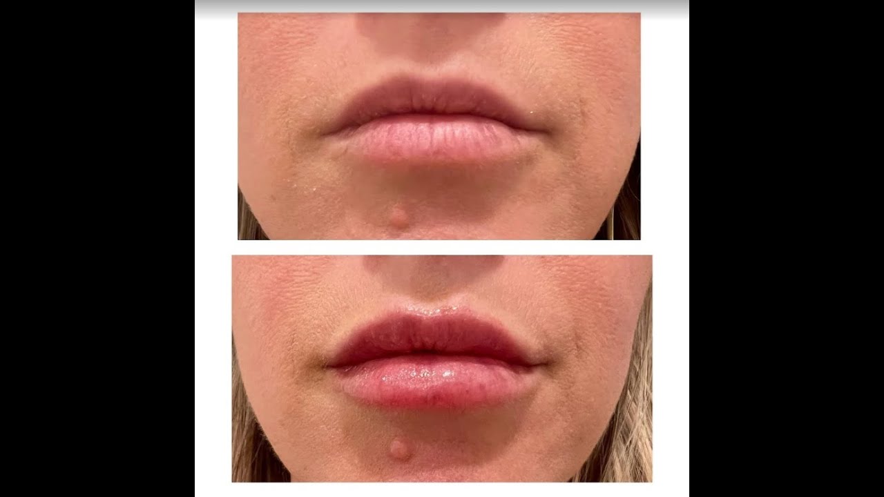 Lip fillers in Denver Colorado  - GATTONI Medical Aesthetics