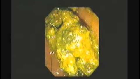 ERCP - Sphincterotomy and Stone Extraction - STEFANOS DOKAS - The ERCP Channel