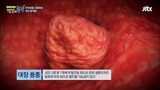 대장암의 씨앗 '대장 용종'의 위험성 건강의 품격 31회