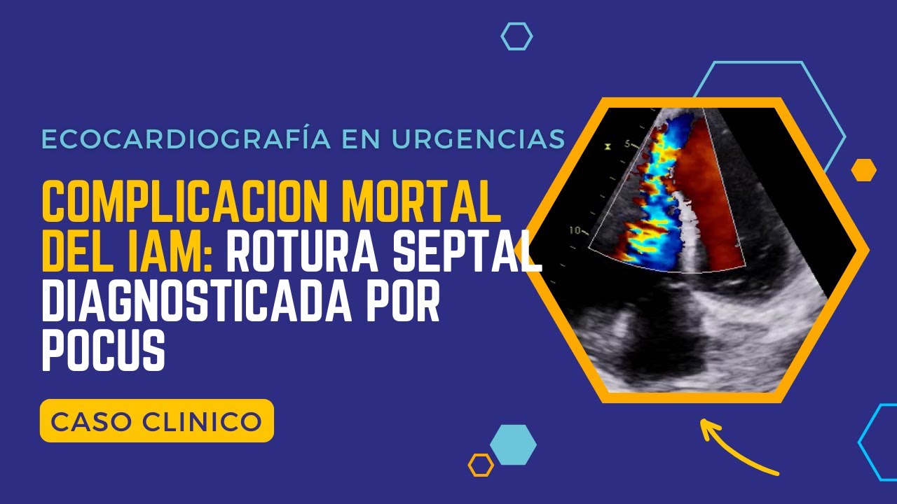 ✅ECOCARDIOGRAMA EN URGENCIAS: Complicación Mortal del IAM: ROTURA SEPTAL diagnosticada por POCUS📌