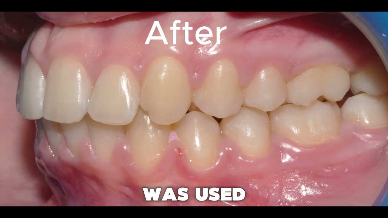 Carriere Class II correction | Tom Nasiopoulos (case D.P.)