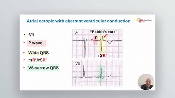 Masterclasses in Electrocardiography - Lecture 1: The Footprints ofAberrant Ventricular Conduction