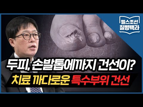 [특수부위 건선] 건선 환자의 손발톱 변형... &rsquo;건선&rsquo;이 원인이라고?