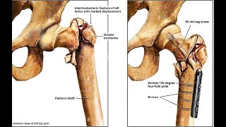 Intertrochanteric  Fractures screenshot 5
