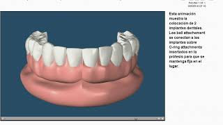 PANORAMICA ATROFIA FACIAL IMPLANTES