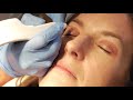 Non surgical blepharoplasty with PLEXR