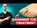 Claw Toe & Hammer Toe Treatment [Straighten Your Toes] NO SURGERY!!!