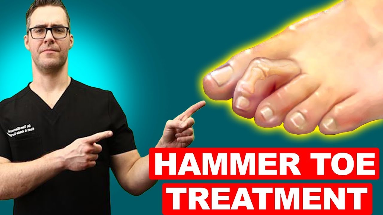 Claw Toe & Hammer Toe Treatment [Straighten Your Toes] NO SURGERY!!!