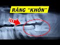 Răng khôn - Răng số 8 có gì đặc biệt? Hiểu rõ trong 5 phút