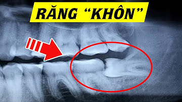 Răng khôn - Răng số 8 có gì đặc biệt? Hiểu rõ trong 5 phút