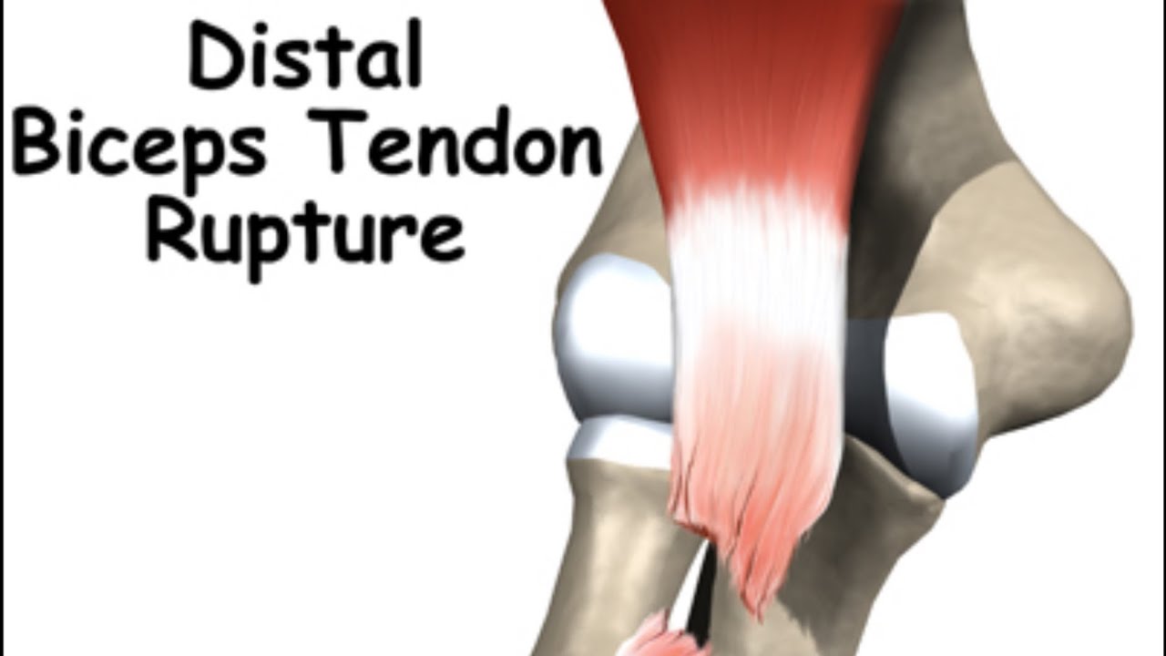 Distal Bicep Tendon Rupture ,Separation ~Three week postop - part 1 ...