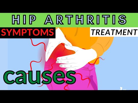 HIP ARTHRITIS - SYMPTOMS,CAUSES,TREATMENT | HIP ARTHRITIS IN HINDI | हि‍प आर्थराइटि‍स | CURE91