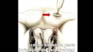 Sinusite Fúngica em seio frontal - Bola Fúngica - HD