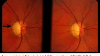 Detection of Progressive Glaucomatous Optic Neuropathy Using Automated Alternation Flicker With Ster