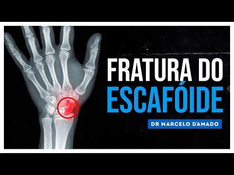 Vídeo: A fratura do escafoide cicatriza?