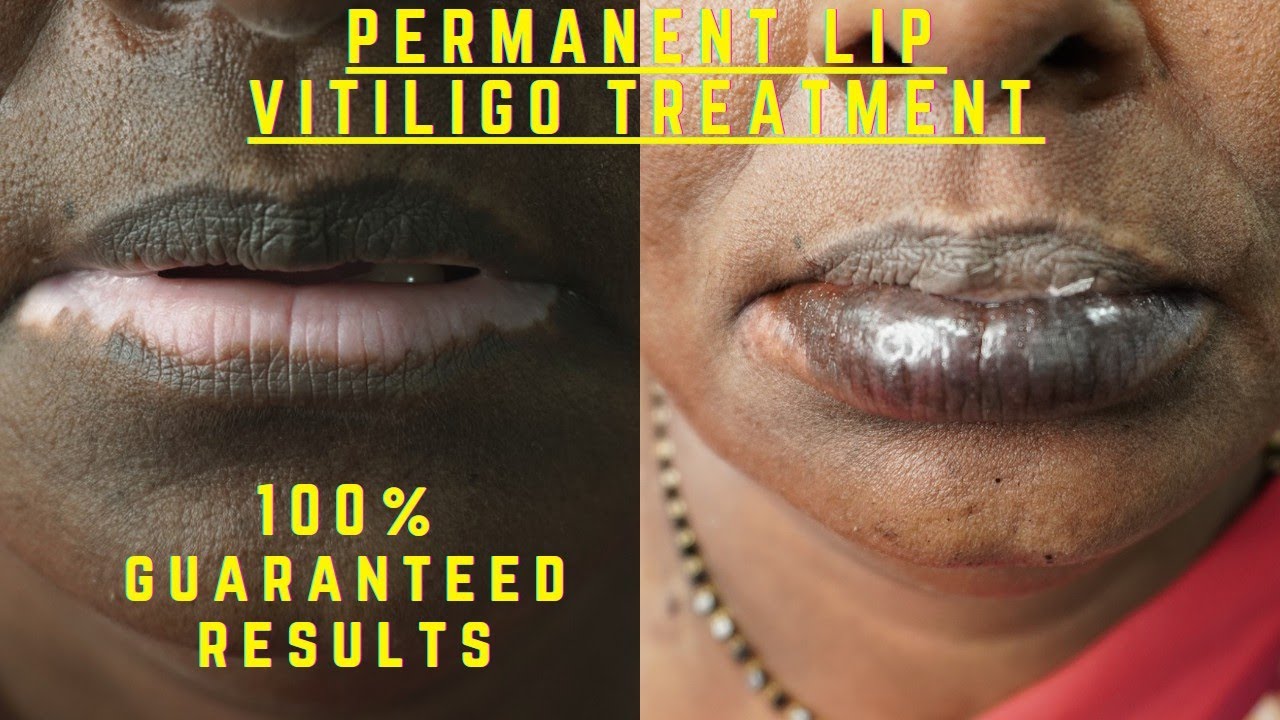 LIPS VITILIGO TREATMENT MAINTENANCE FREE SAFED DAAG ILAJ LIP