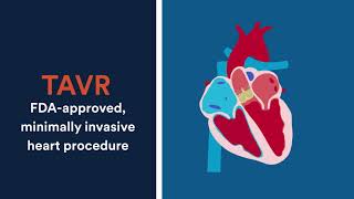 What to know about Transcatheter Aortic Valve Replacement