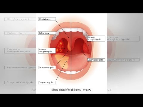 Ostre i przewlekłe zapalenie gardła